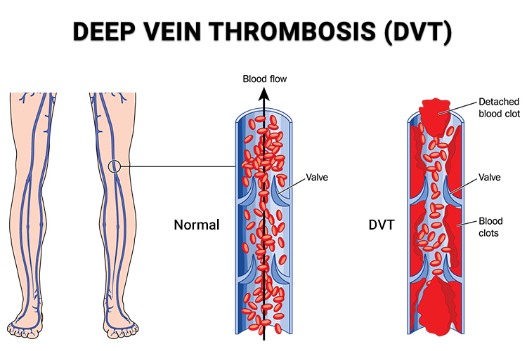 Deep Vein Thrombosis (DVT)