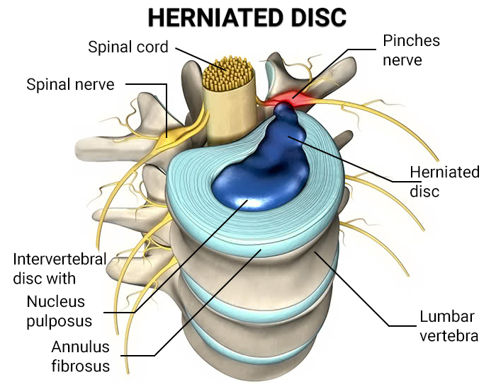 Herniated Disc