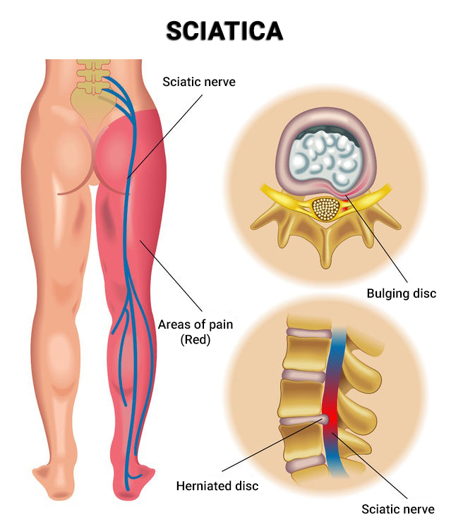 Sciatica