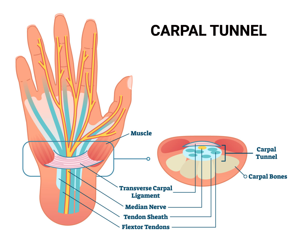 Carpal Tunnel