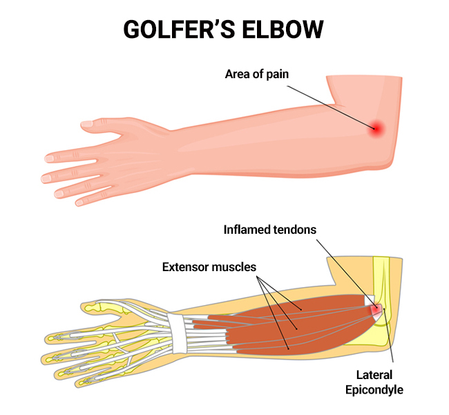 Golfers Elbow NY