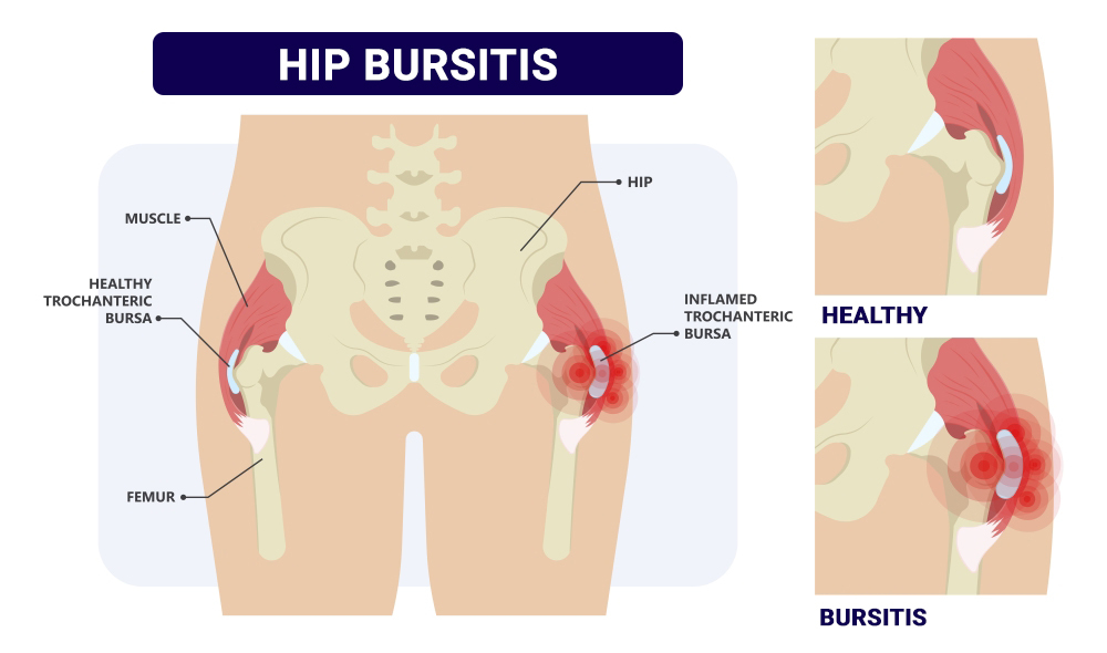 Hip Bursitis NY