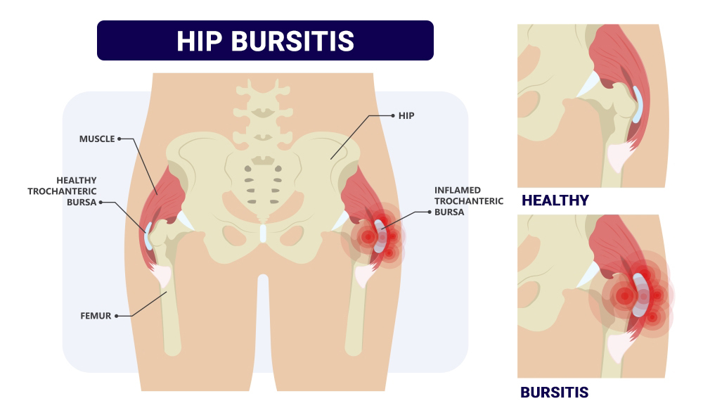 Hip pain: What causes it? What can you do about it?