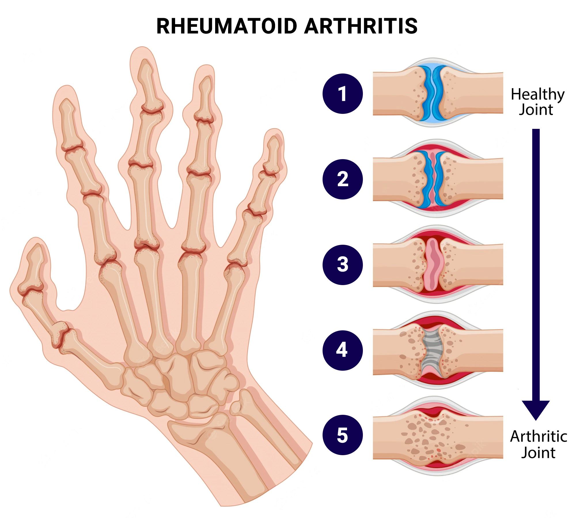 Treating Sciatica Pain at Home and in the RA Office