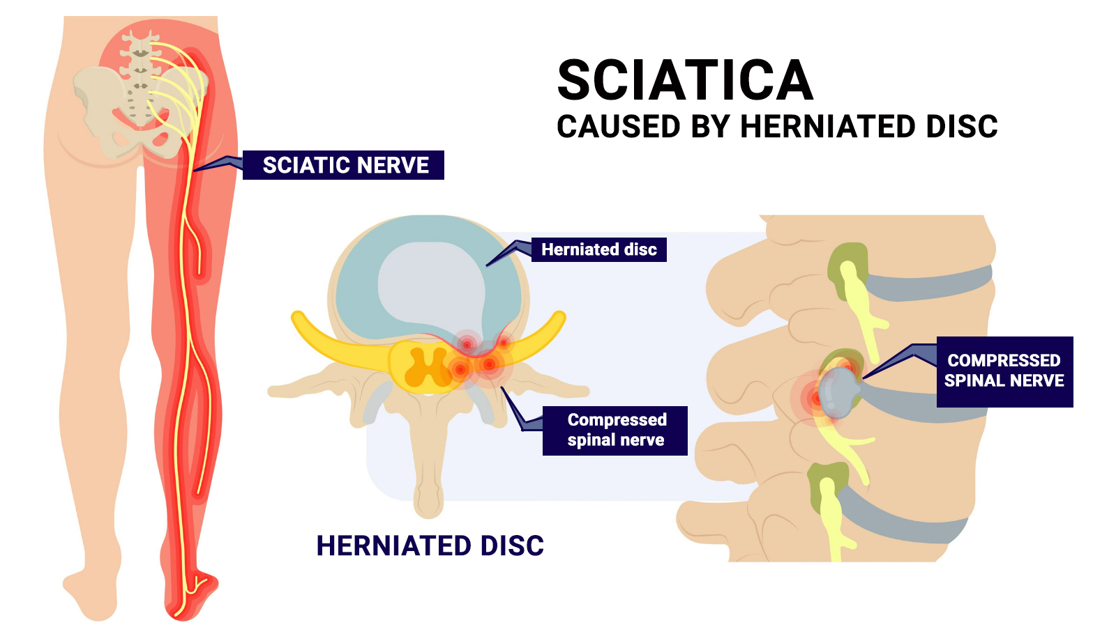 Get Therapy For Sciatic Nerve Pain