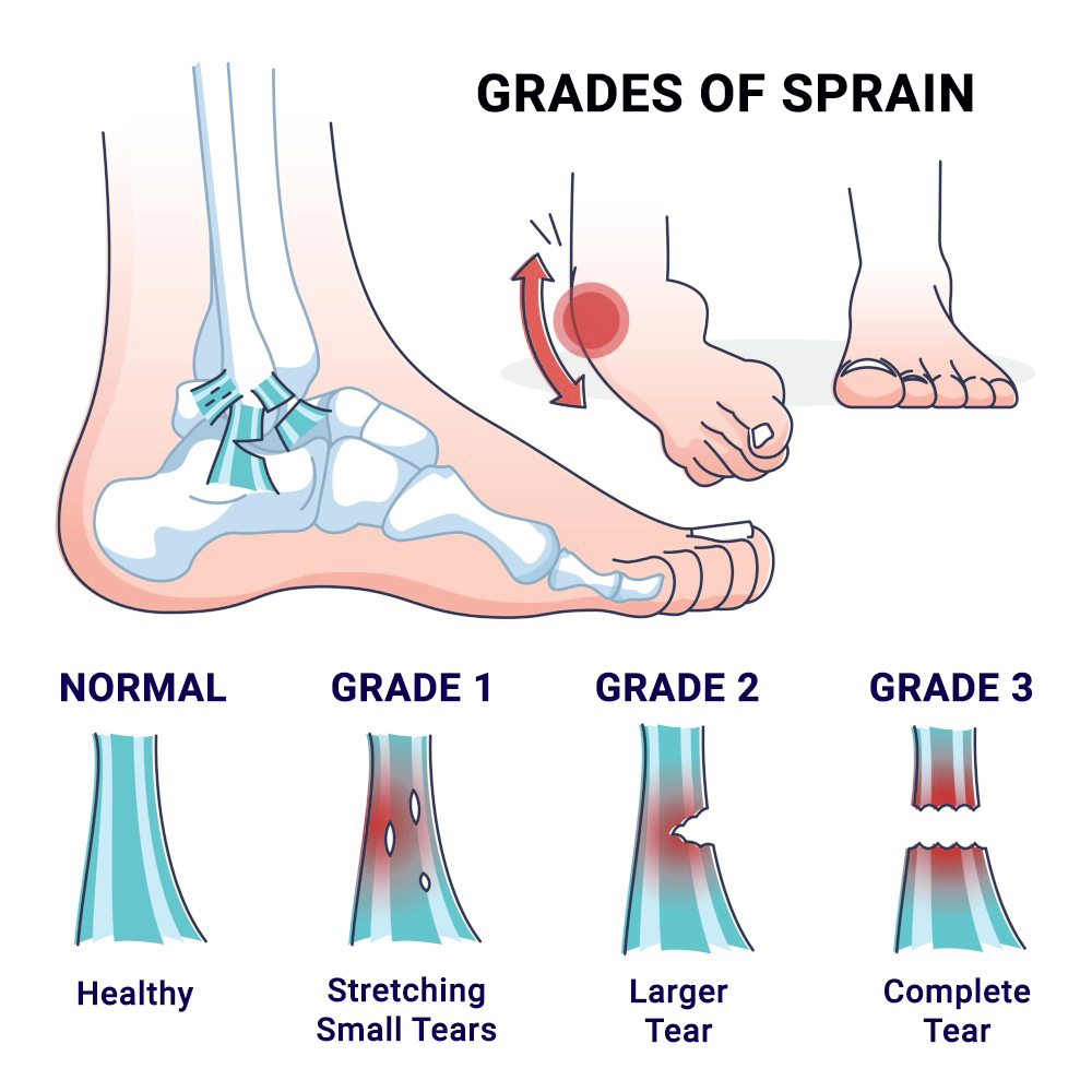 Physical Therapy For Sprained Ankle - Physical Therapists NYC