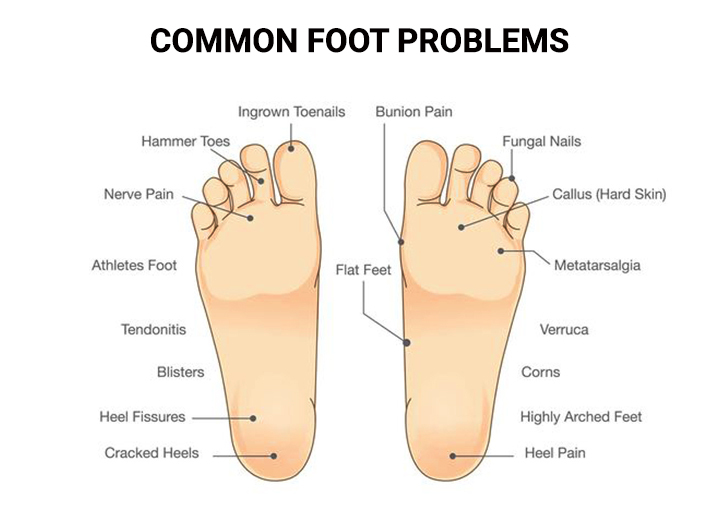 Foot Pain in NY