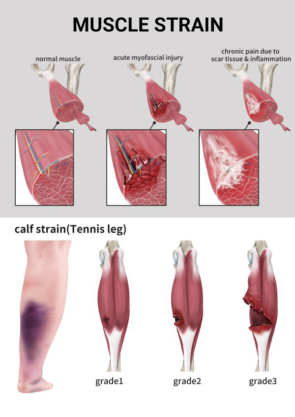 Muscle Strain