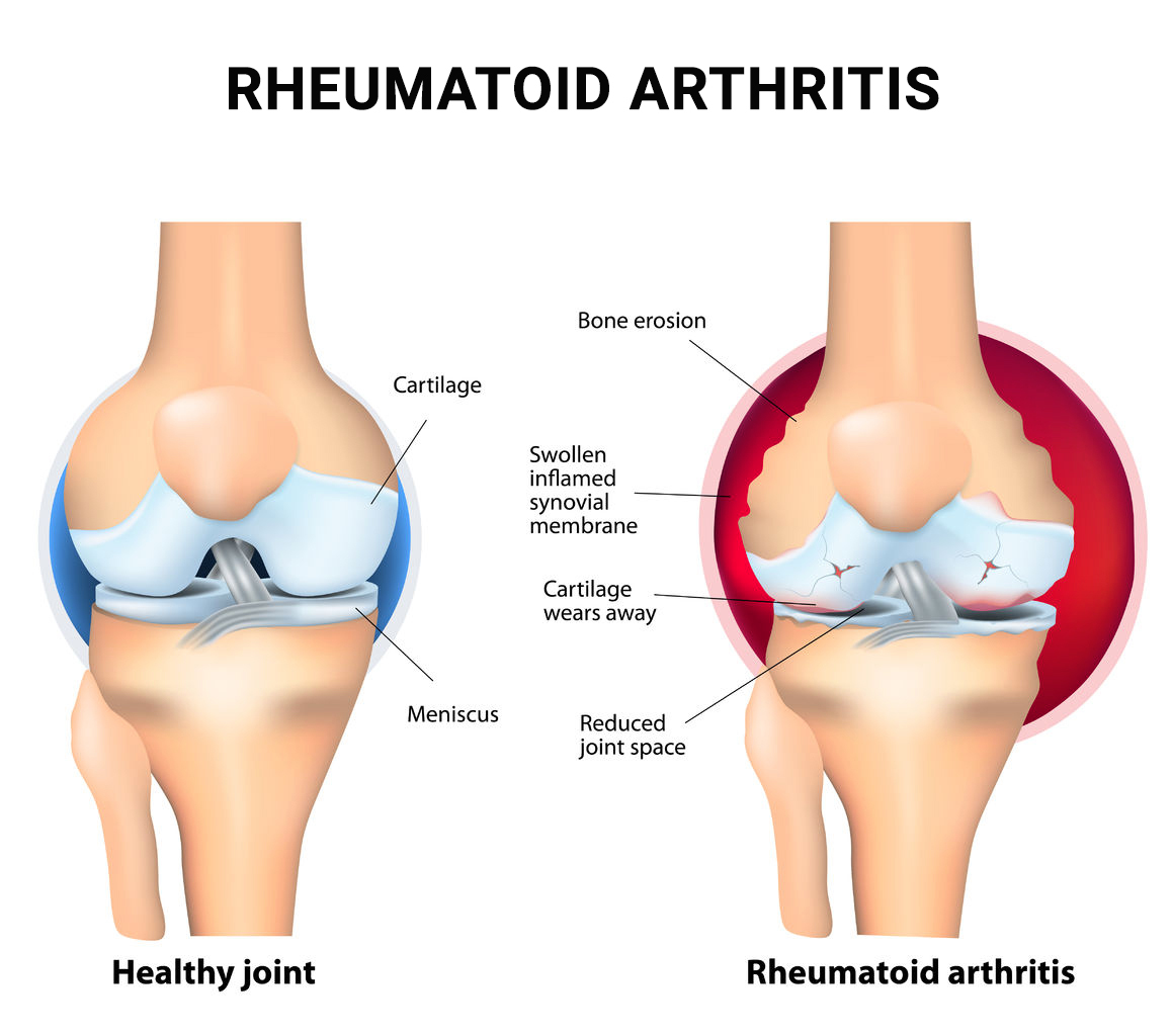 Rheumatoid Arthritis NYC