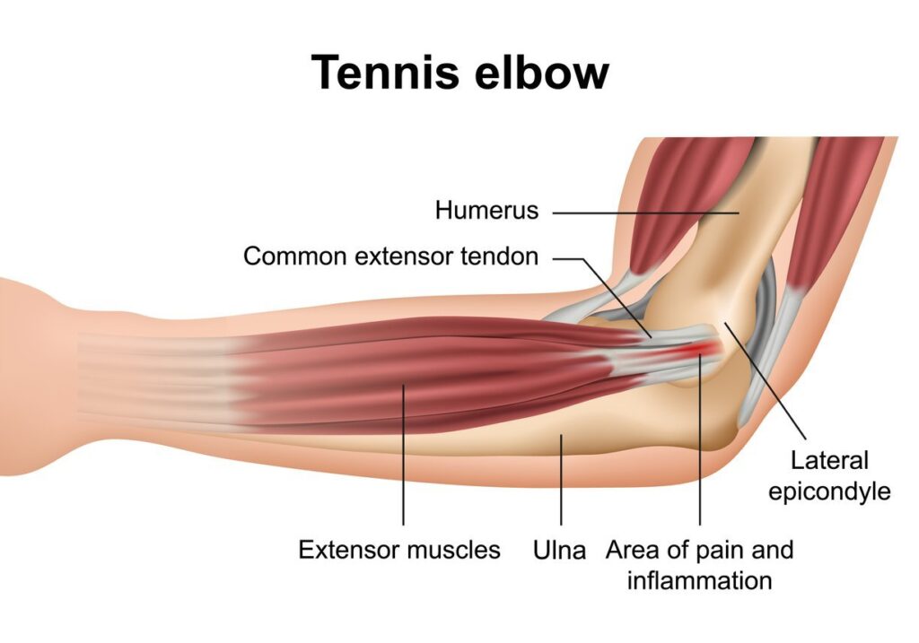 tennis-elbow