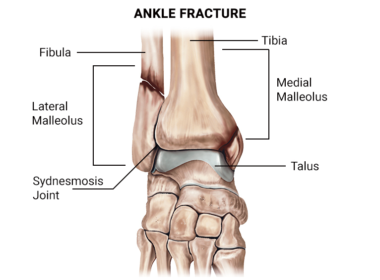 Ankle fracture