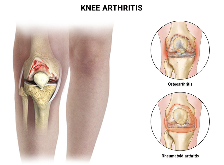 Knee Arthritis