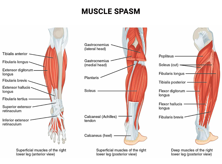 Lower Leg Muscle Cramps, Musculoskeletal Pain