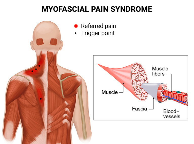 Myofascial Pain Syndrome