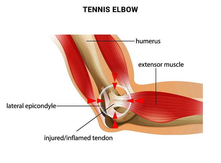 Tennis Elbow